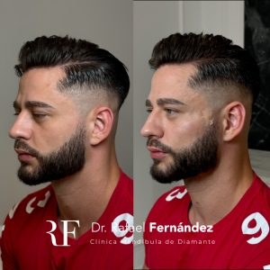 hilos tensores faciales